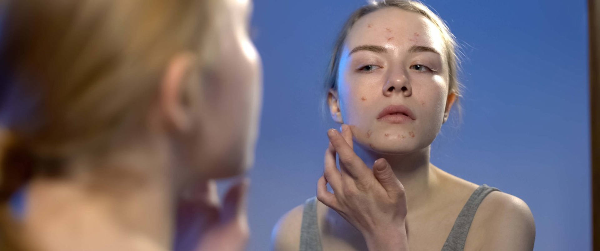 Kuranda vitiligo tedavisi