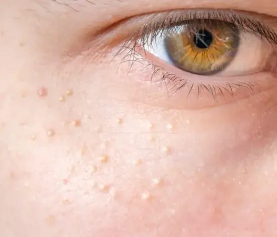 Yüzdeki Yağ Bezeleri Neden Olur? Nasıl Geçer?