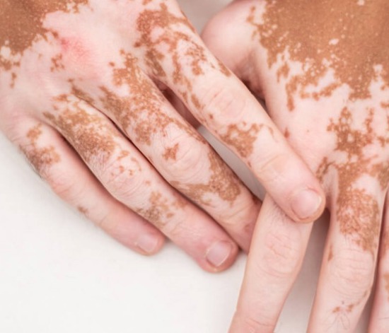 Vitiligo Tedavi Yöntemleri Nedir?