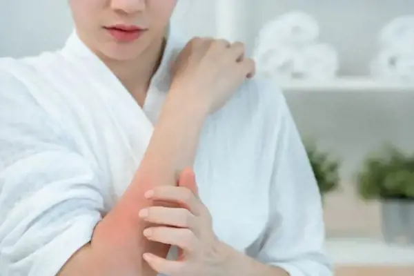 Ürtiker (Kurdeşen) Nedir? Neden Olur?